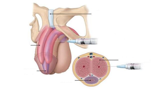 injections pour améliorer la puissance